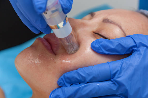 Boost Collagen With Advanced Microneedling collagen boosting microneedling